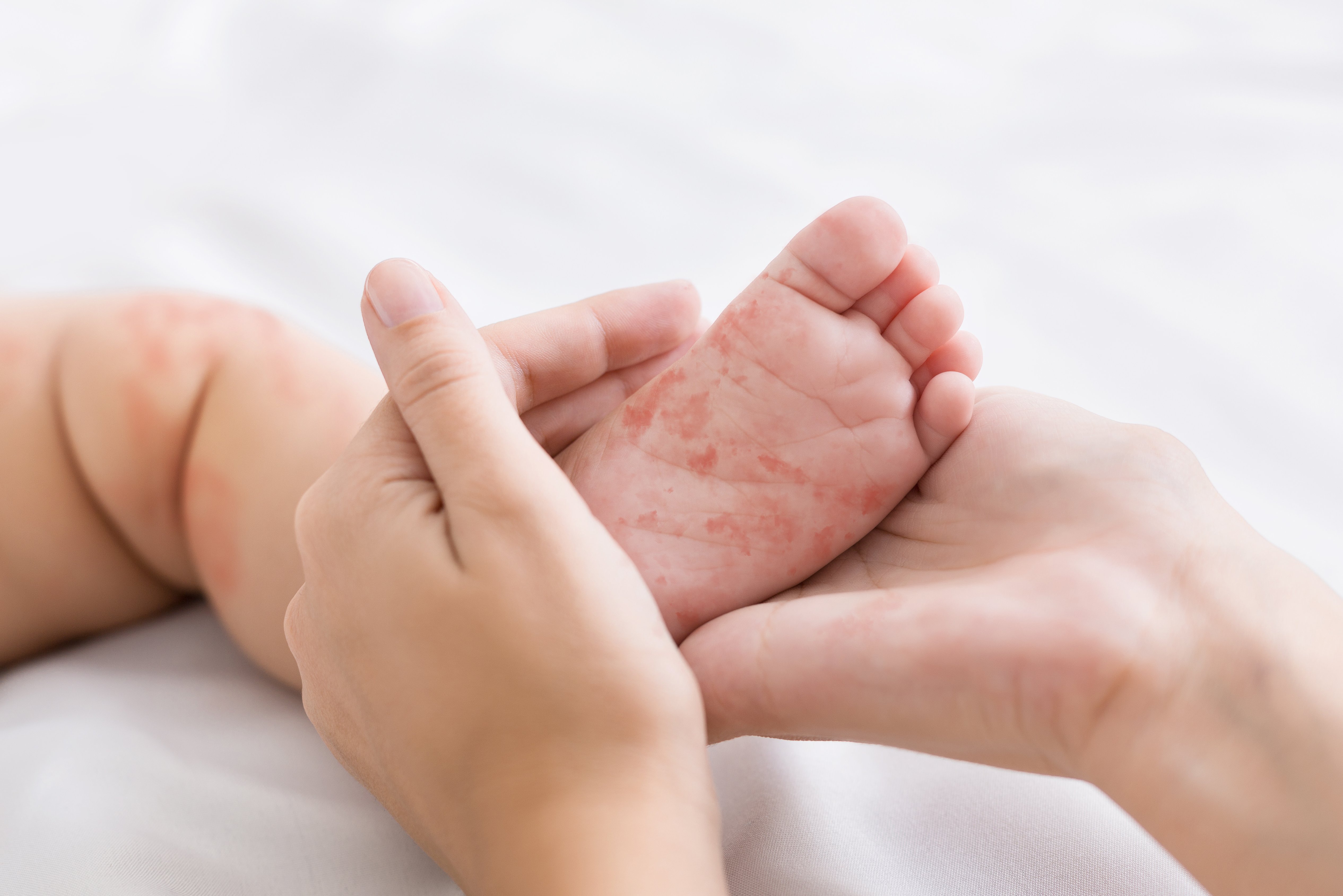 Mother holding tiny baby foot with measles rash